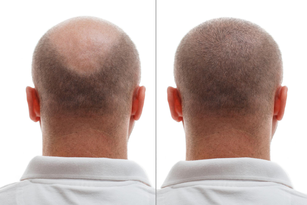 a-cabeca-de-um-homem-calvo-antes-e-depois-da-cirurgia-de-transplante-de-cabelo-um-homem-que-perde-o-cabelo-tornou-se